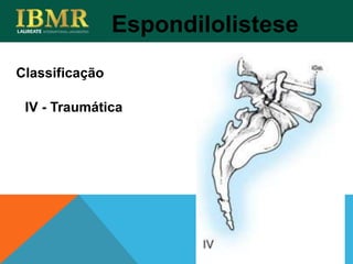 Espondilolistese
IV - Traumática
Classificação
 