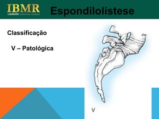Espondilolistese
V – Patológica
Classificação
 