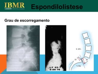 Espondilolistese
Grau de escorregamento
 
