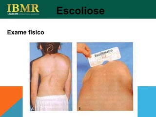 Exame físico
Escoliose
 