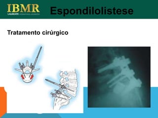 Tratamento cirúrgico
Espondilolistese
 