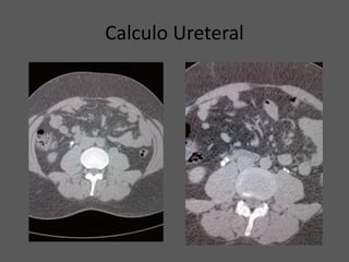 Calculo Ureteral
 