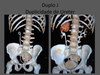 Duplo J
Duplicidade de Ureter
 