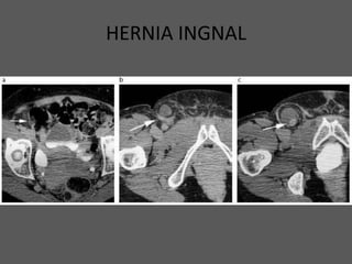 HERNIA INGNAL
 