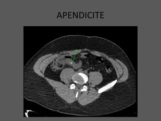 APENDICITE
 