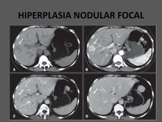 HIPERPLASIA NODULAR FOCAL
 