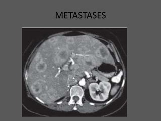 METASTASES
 
