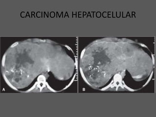 CARCINOMA HEPATOCELULAR
 