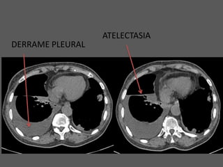 ATELECTASIA
DERRAME PLEURAL
 