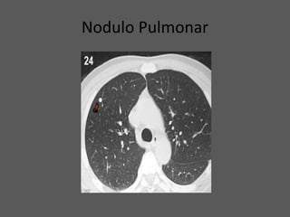 Nodulo Pulmonar
 