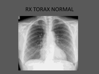 RX TORAX NORMAL
 