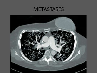 METASTASES
 
