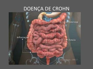 DOENÇA DE CROHN
 