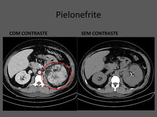 Pielonefrite
COM CONTRASTE SEM CONTRASTE
 