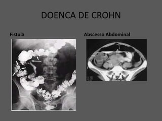 DOENCA DE CROHN
Fistula Abscesso Abdominal
 