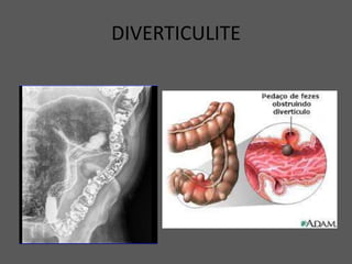 DIVERTICULITE
 