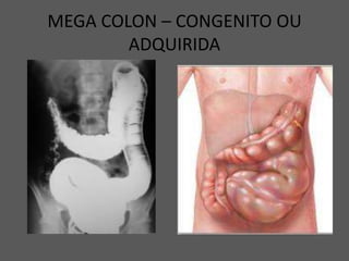 MEGA COLON – CONGENITO OU
ADQUIRIDA
 