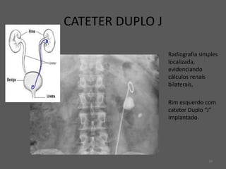 39
Radiografia simples
localizada,
evidenciando
cálculos renais
bilaterais,
Rim esquerdo com
cateter Duplo “J”
implantado.
CATETER DUPLO J
 