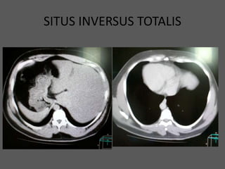 SITUS INVERSUS TOTALIS
 