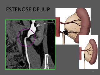 40
ESTENOSE DE JUP
 