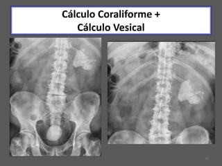 42
Cálculo Coraliforme +
Cálculo Vesical
 