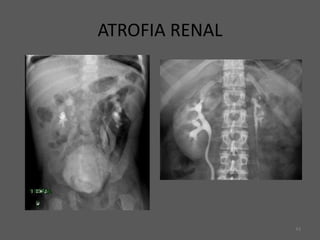 43
ATROFIA RENAL
 