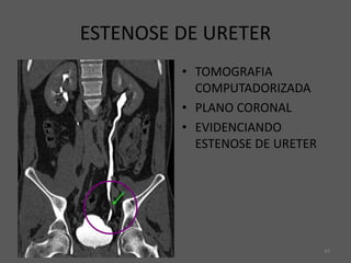 44
ESTENOSE DE URETER
• TOMOGRAFIA
COMPUTADORIZADA
• PLANO CORONAL
• EVIDENCIANDO
ESTENOSE DE URETER
 