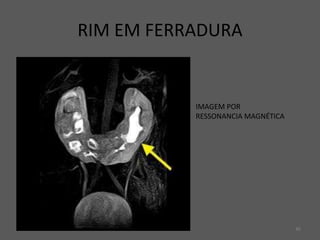 45
RIM EM FERRADURA
IMAGEM POR
RESSONANCIA MAGNÉTICA
 