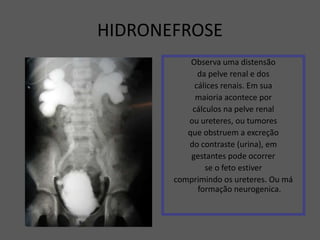 HIDRONEFROSE
Observa uma distensão
da pelve renal e dos
cálices renais. Em sua
maioria acontece por
cálculos na pelve renal
ou ureteres, ou tumores
que obstruem a excreção
do contraste (urina), em
gestantes pode ocorrer
se o feto estiver
comprimindo os ureteres. Ou má
formação neurogenica.
 