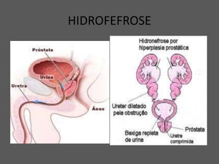 HIDROFEFROSE
 