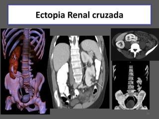 51
Ectopia Renal cruzada
 