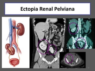 52
Ectopia Renal Pelviana
 