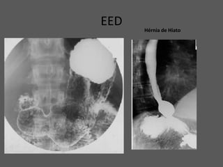 EED Hérnia de Hiato
 