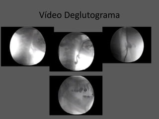Vídeo Deglutograma
 