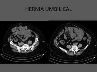 HERNIA UMBILICAL
 