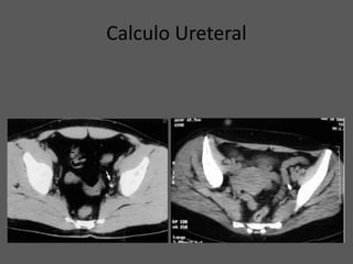 Calculo Ureteral
 