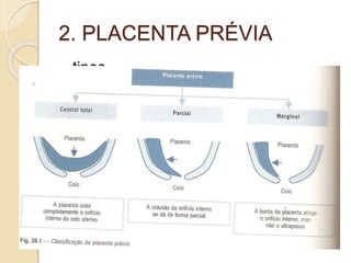 2. PLACENTA PRÉVIA 
 tipos 
 Hermogenes pg 268 
 Fig 26.1 
 