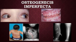 OSTEOGENECIS
IMPERFECTA
 