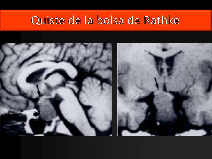 Kyste De La Poche De Rathke Opération