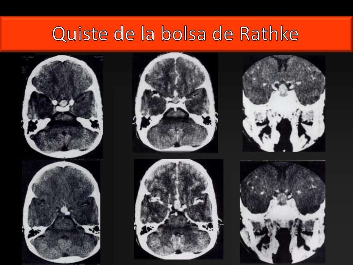 Kyste De La Poche De Rathke Opération
