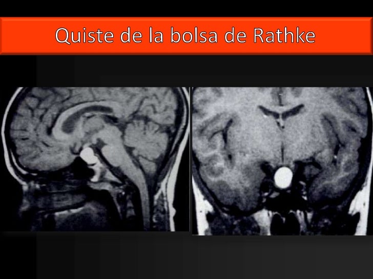 Kyste De La Poche De Rathke Opération