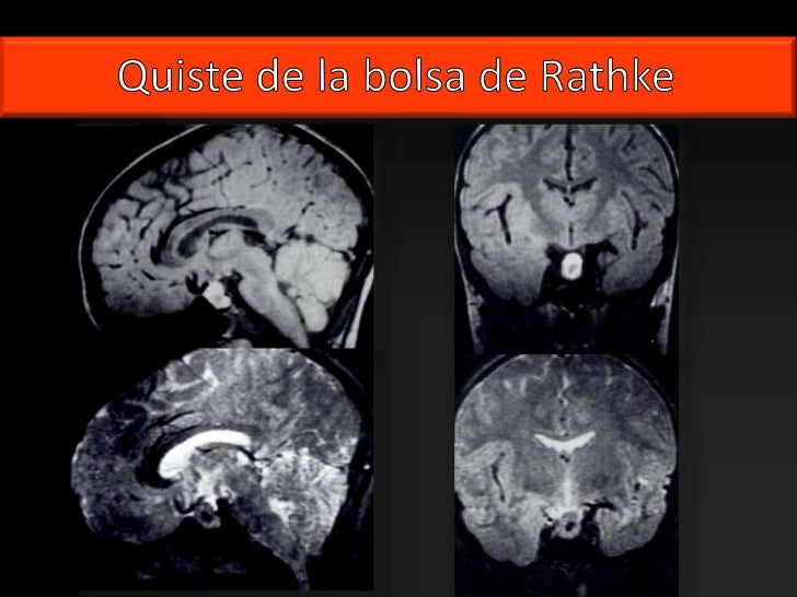 Kyste De La Poche De Rathke Opération