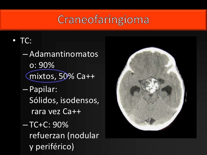Patología de la Silla Turca