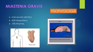MIASTENIA GRAVIS
 Intervención del timo
 65% hiperplásico
 10% timomas.
FISIOPATOLOGIA
 