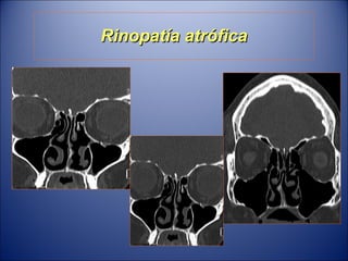 Rinopatía atrófica 