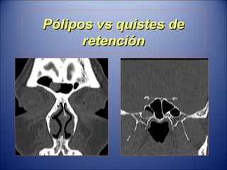 Pólipos vs quistes de retención 