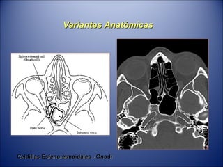 Variantes Anatómicas Celdillas Esfeno-etmoidales - Onodi 