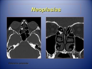 Neoplasias Osteoma osteoide 