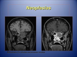 Neoplasias Metástasis Ca células escamosas renales 