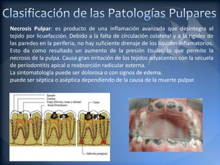 Necrosis Pulpar: es producto de una inflamación avanzada que desintegra el
tejido por licuefacción. Debido a la falta de circulación colateral y a la rigidez de
las paredes en la periferia, no hay suficiente drenaje de los líquidos inflamatorios.
Esto da como resultado un aumento de la presión tisular, lo que permite la
necrosis de la pulpa. Causa gran irritación de los tejidos adyacentes con la secuela
de periodontitis apical o reabsorción radicular externa.
La sintomatología puede ser dolorosa o con signos de edema.
puede ser séptica o aséptica dependiendo de la causa de la muerte pulpar.
 